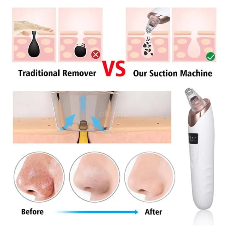 Face Vacuum Suction Blackhead Remover Pore Cleaner